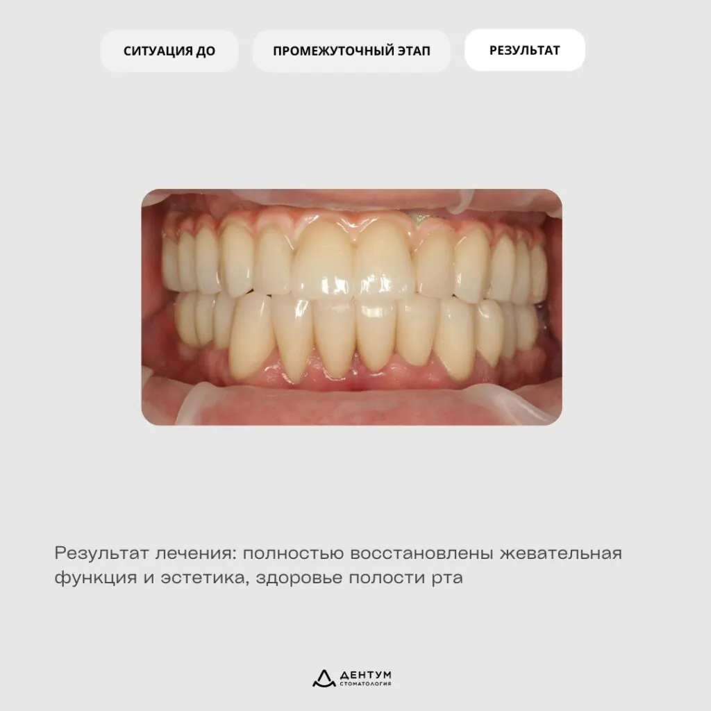 Имплантация «All-on-6», фото 4