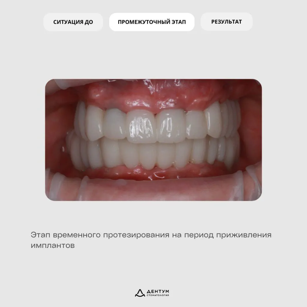 Кейс: Восстановление зубного ряда по протоколу «All-on-6», фото 3