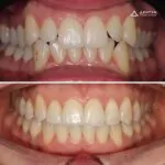 Комплексное лечение: ортодонтия, имплантация и восстановление зуба, фото 1