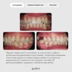 Комплексное лечение: ортодонтия, имплантация и восстановление зуба, фото 2