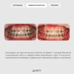 Комплексное лечение: ортодонтия, имплантация и восстановление зуба, фото 3