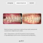 Комплексное лечение: ортодонтия, имплантация и восстановление зуба, фото 4