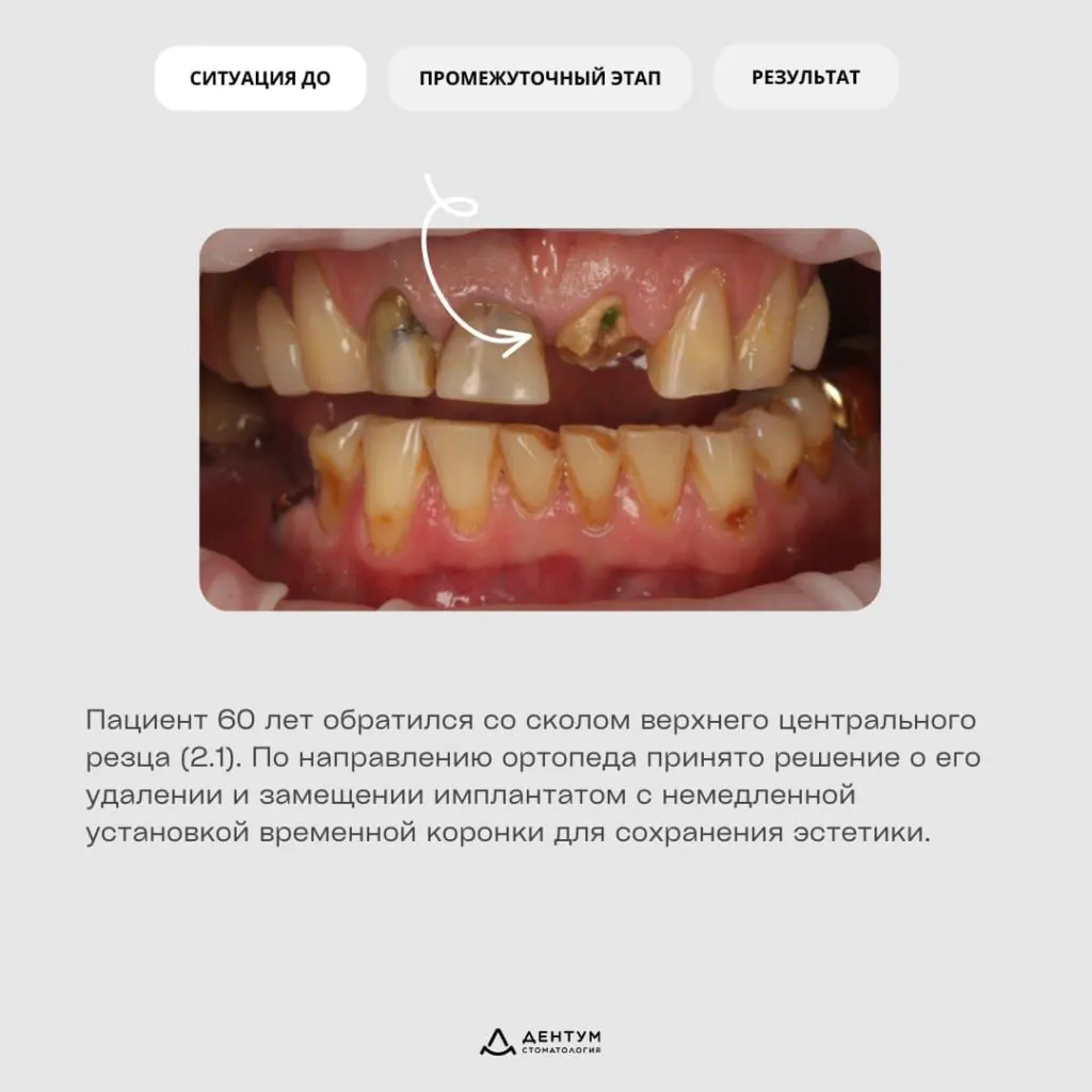 Немедленная имплантация зуба 2.1 с использованием шаблона и временной коронки, фото 2