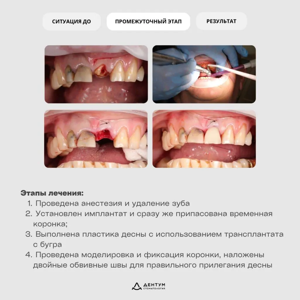 Немедленная имплантация зуба 2.1 с использованием шаблона и временной коронки, фото 4