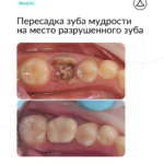 Аутотрансплантация (пересадка) зуба мудрости на место 36 зуба с последующим протезированием, фото 1