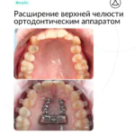Расширение верхней челюсти ортодонтическим аппаратом MARPE (Марпе) — коррекция прикуса, фото 1