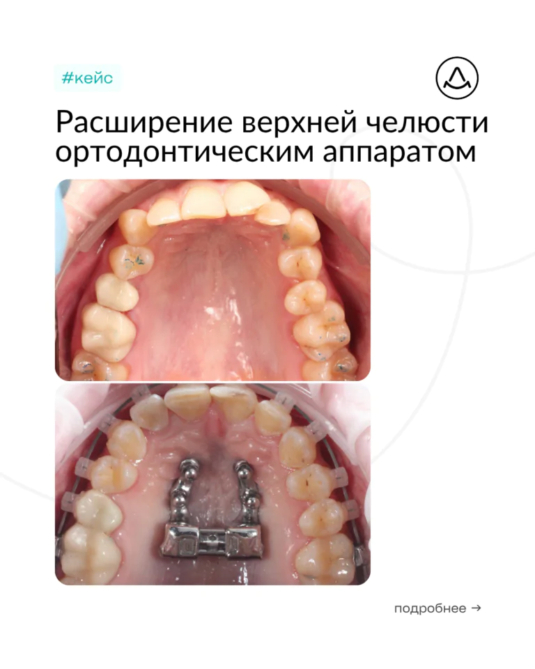 Расширение верхней челюсти ортодонтическим аппаратом MARPE (Марпе) — коррекция прикуса