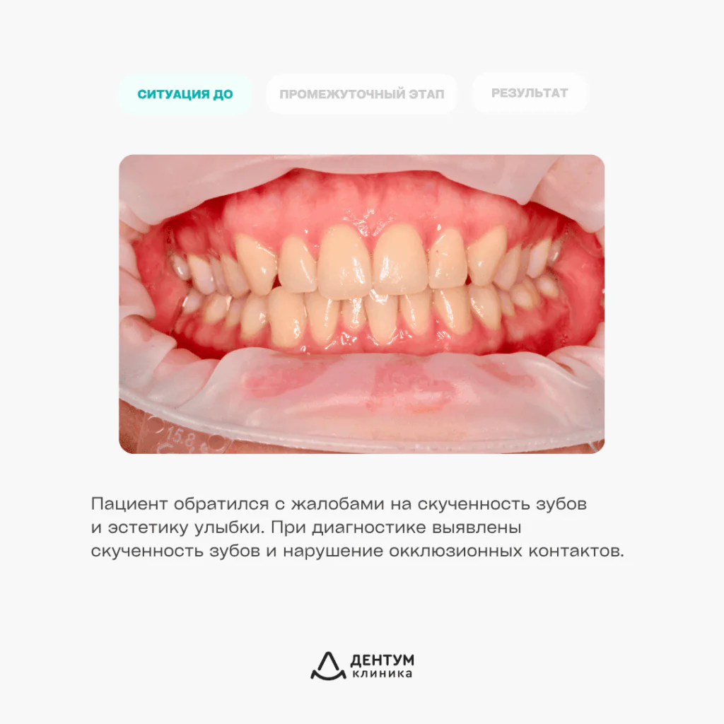 Исправление скученности зубов на брекет-системе Damon, фото 2