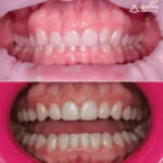 Ортодонтическое лечение на элайнерах FlexiLigners и коррекция уровня десны, фото 1