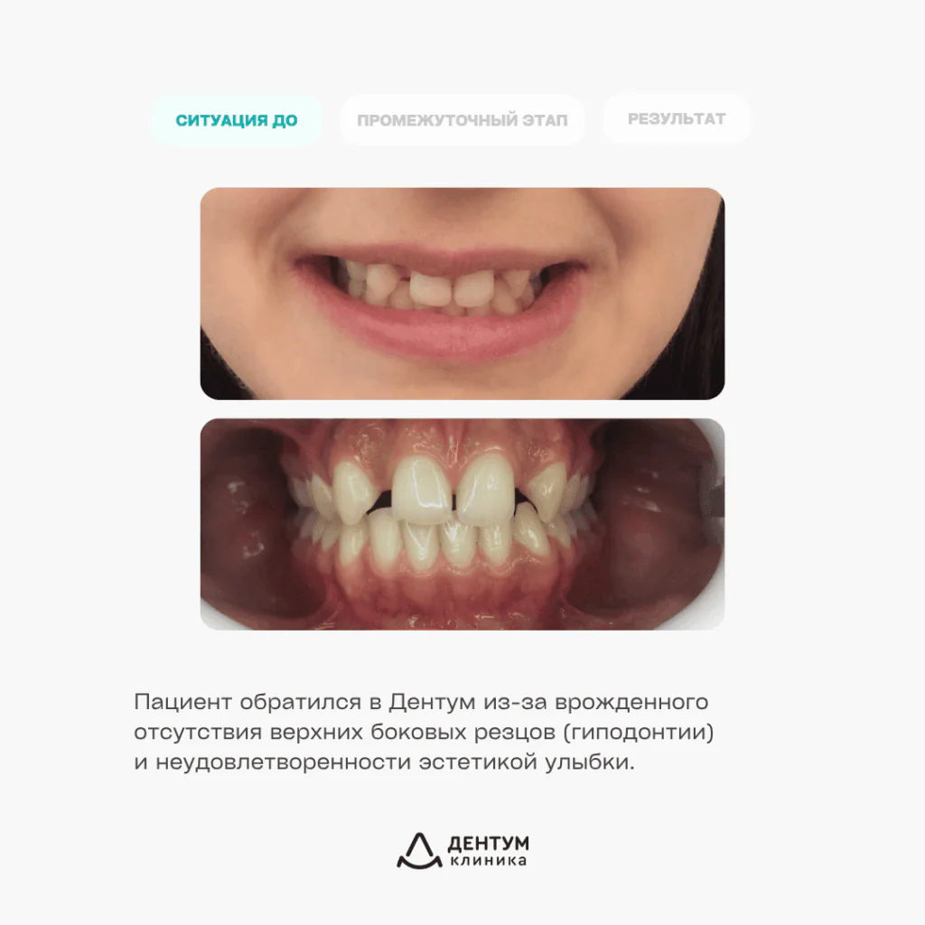 Комплексное лечение гиподонтии (врожденного отстутствия передних резцов), фото 2