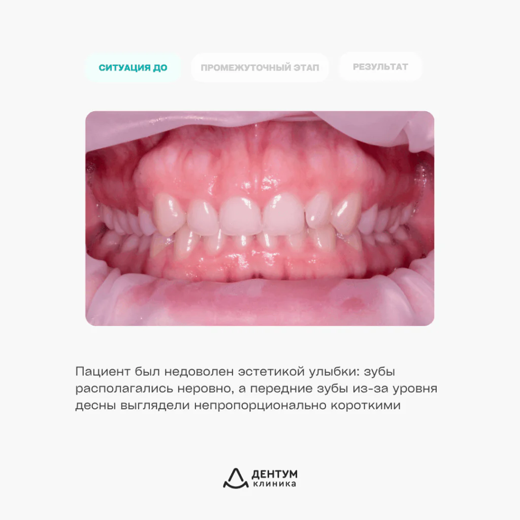 Ортодонтическое лечение на элайнерах FlexiLigners и коррекция уровня десны, фото 2