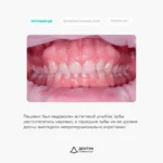 Ортодонтическое лечение на элайнерах FlexiLigners и коррекция уровня десны, фото 2