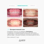 Ортодонтическое лечение на элайнерах FlexiLigners и коррекция уровня десны, фото 3
