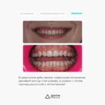 Ортодонтическое лечение на элайнерах FlexiLigners и коррекция уровня десны, фото 5