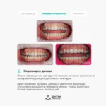 Ортодонтическое лечение на элайнерах FlexiLigners и коррекция уровня десны, фото 4